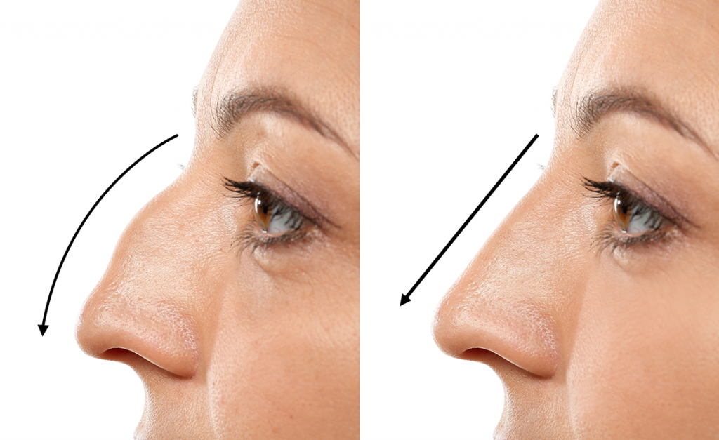 Rhinoplasty in Dubai