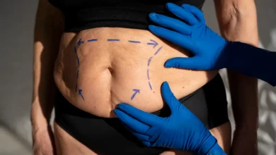 Liposuction in Dubai