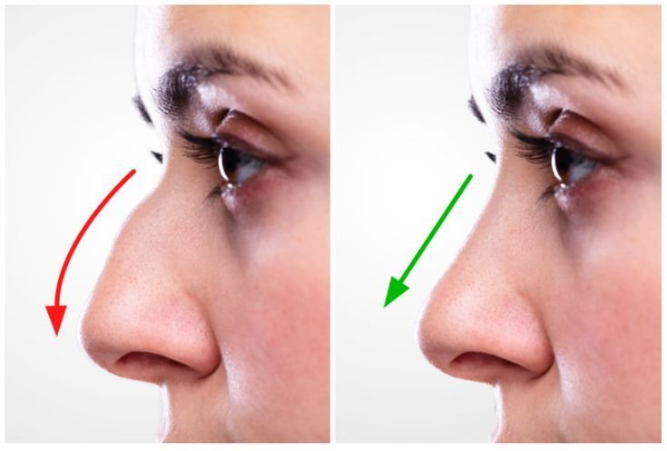 Where to Get Safe Rhinoplasty in Islamabad?